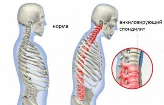 анкилозирующий спондилит