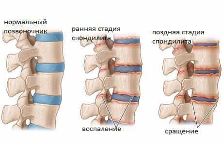 анкилозирующий спондилит