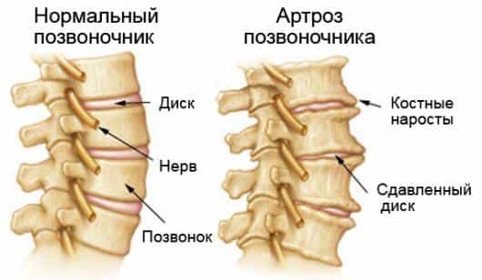 артроз позвоночника