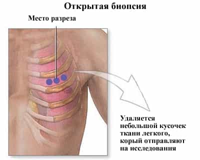 биопсия легкого