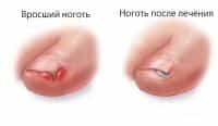 Схема вросшего ногтя