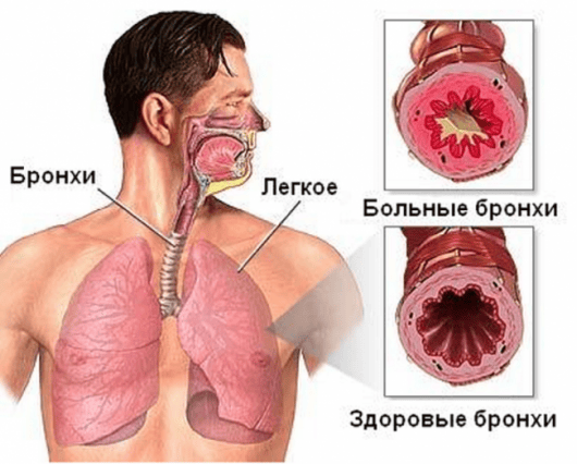 бронхи во время бронхита