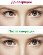 Глаза до операции и после