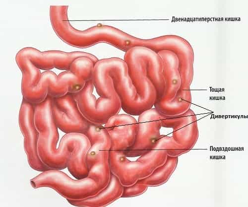 дивертикулит тонкой кишки
