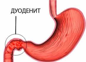 дуоденит