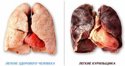 что такое эмфизема легких