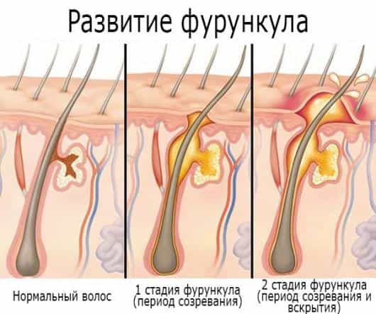 Фурункул