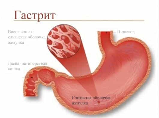 гастрит