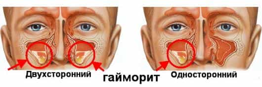 гайморит