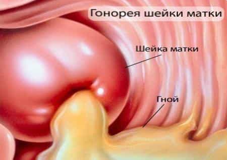 Гонорея шейки матки