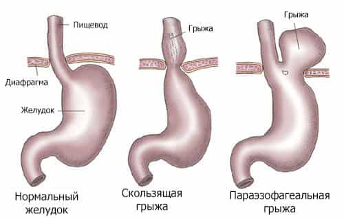 грыжа желудка