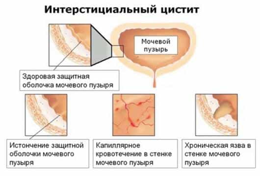 Интерстициальный цистит