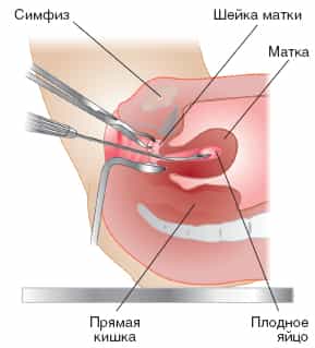 схема аборта