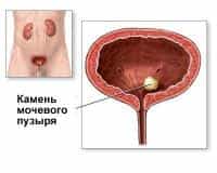 камни в мочевом пузыре