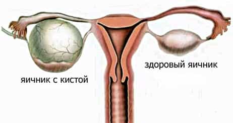киста яичника