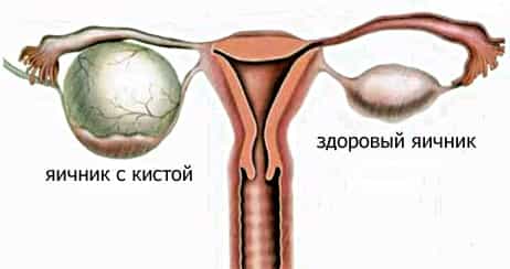 киста яичника