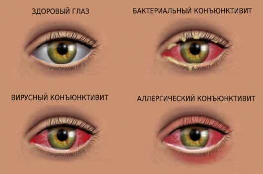 виды конъюнктивита