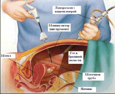 лапароскопия кисты яичника