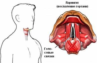 ларингит
