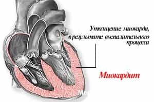 миокардит