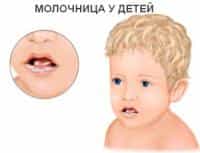 молочница у детей