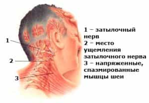 невралгия затылочного нерва