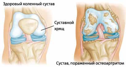 остеоартрит колена