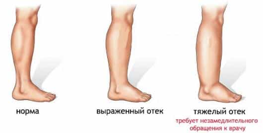 Отёк