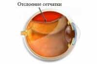 Отслоение сетчатки