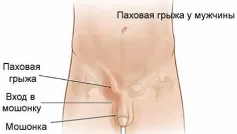 паховая грыжа у мужчин