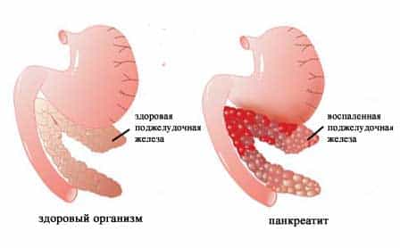панкреатит