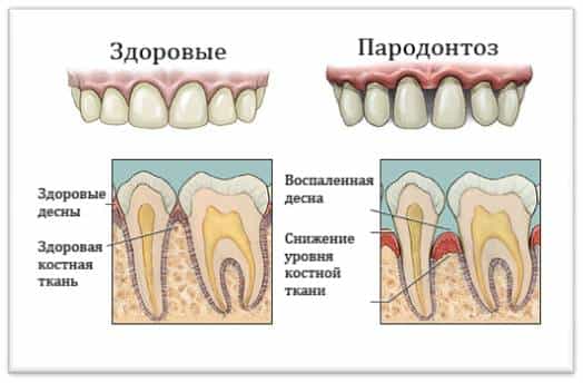 пародонтоз