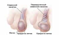 перекручивание семенного канатика