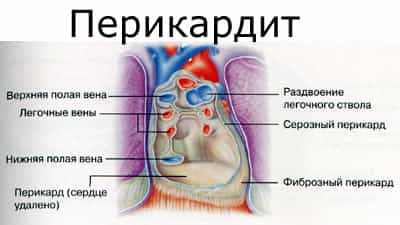 перикардит