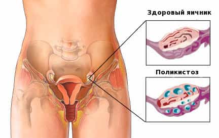 поликистоз яичников