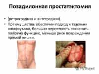позадилонная простатэктомия