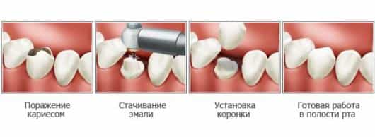 принцип действия коронки