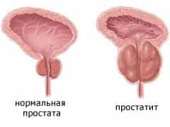 простатит