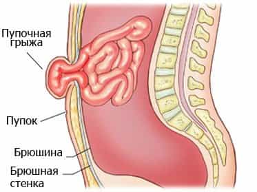 пупочная грыжа