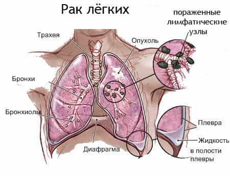 рак легких