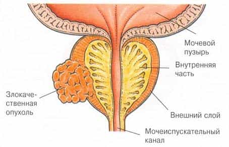 рак предстательной железы