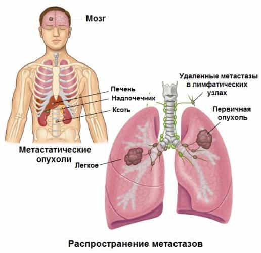 распространение рака легких