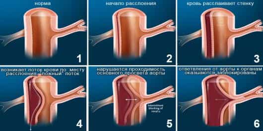 расслаивающая аневризма аорты