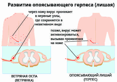 развитие опоясывающего герпеса