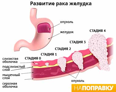 развитие рака желудка