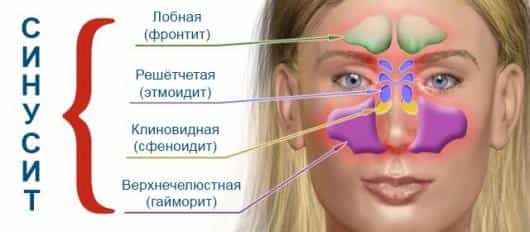 синусит