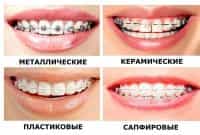 брекеты