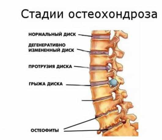 стадии остеохондроза