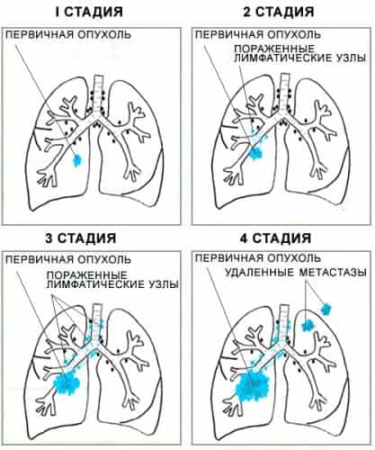 стадии рака легких
