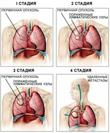 стадии рака легких